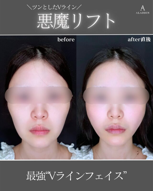 .大人気の糸リフト！『天使リフト👼』✖️『悪魔リフト😈』．今回は悪魔リフトの症例です。4本の糸で輪郭を作りました。【天使リフト】とは？天使リフトとは、糸リフトで頬を上げることにより“ラプンツェル”のように《中顔面が短く》見える輪郭になります。【悪魔リフト】とは？悪魔リフトとは、糸リフトでvラインに上げることにより“マレフィセント“のような《シュッとした》輪郭になります。．年間5000例以上の症例をこなしているからできることもあります。技術があれば糸リフトで理想の輪郭も作れます。『嘘のない美容医療』の実現へ確かな技術で良いものだけを提供するクリニックNo.1よりあなたのオンリーワンになる【アラジン美容クリニック】■価格2本　14.08万円4本　22万円　6本　26.4万円8本　39.6万円（1年保証付4本）10本　44万円（1年保証付4本）12本　52.8万円（1年保証付6本）入れ放題　32万円■想定されるリスクなど☑腫れ　　　術後数日～1週間。☑内出血　　まれ。メイクで隠せる程度。☑傷跡　　　術後数日間。メイクで隠せる程度。☑糸の影響　口の開けづらさなど。時間経過で解消。☑糸の感染　熱感・赤み・強い痛みが持続する場合、感染症が疑われる。糸を抜糸し抗生剤を服用。．#美容整形#美容#整形#美容整形#プチ整形#糸リフト#糸リフト経過#ダウンタイム#小顔#小顔形成#リフトアップ